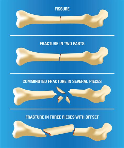 Different Types Of Fractures Kulturaupice