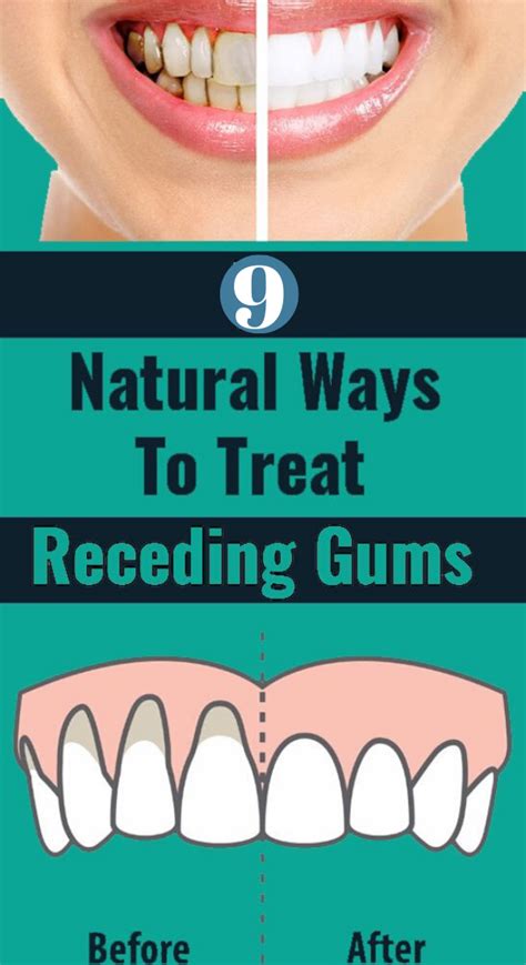 9 Easy Ways To Heal Receding Gums Naturally Receding Gums Gum
