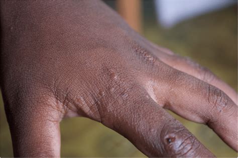 Typical Scabies Lesions On A Childs Fingers Download Scientific Diagram