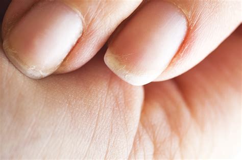 Peeling Nails Heres 8 Reasons Why Its Happening
