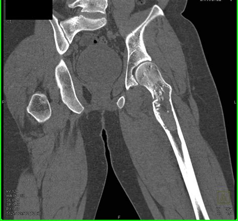 Fracture Through A Bone Cyst In The Left Femur Musculoskeletal Case