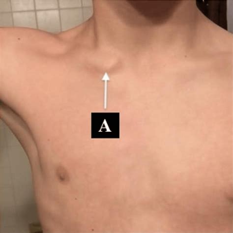 Cureus Snapping Sternoclavicular Joint