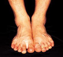 macchie rosse sui piedi e caviglie - Itsanitas.com