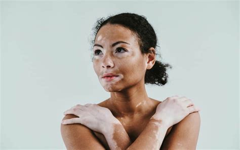 Vitiligo Skin Condition And Treatments A Full Overview