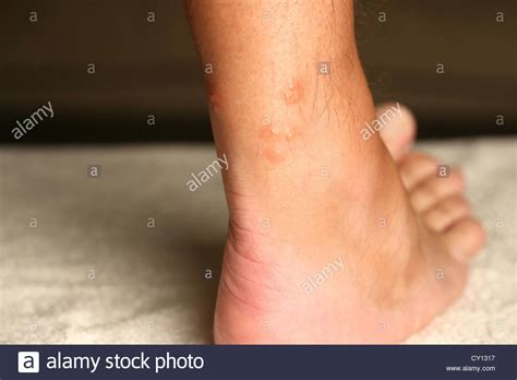 Bed Bug Bites Hi Res Stock Photography And Images Alamy