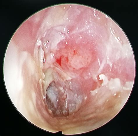 6 Otitis Externa Picture Shows Intact Tympanic Membrane With Severely