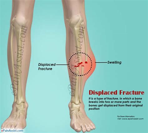 Displaced Fracturetypescausessymptomstreatmentrecovery Period