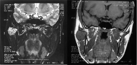 Mri Of A Hemangioma In The Superior Part Of The Parotid Gland Note The