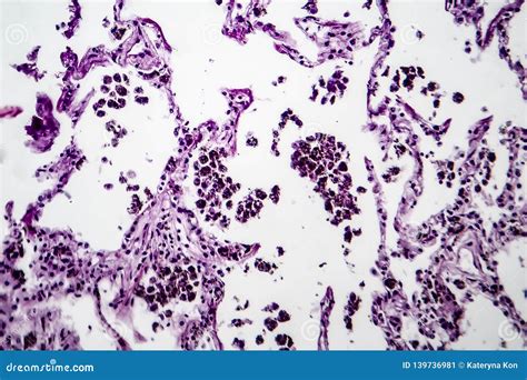 Lung Emphysema Light Micrograph Stock Image Image Of Pathology