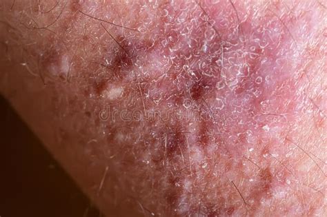 Lichen Planus On Leg Skin Close Up Dermatological Disease In Form Of