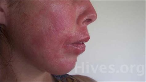 Hives Treatment Center Causes Symptoms And Pictures Of Urticaria