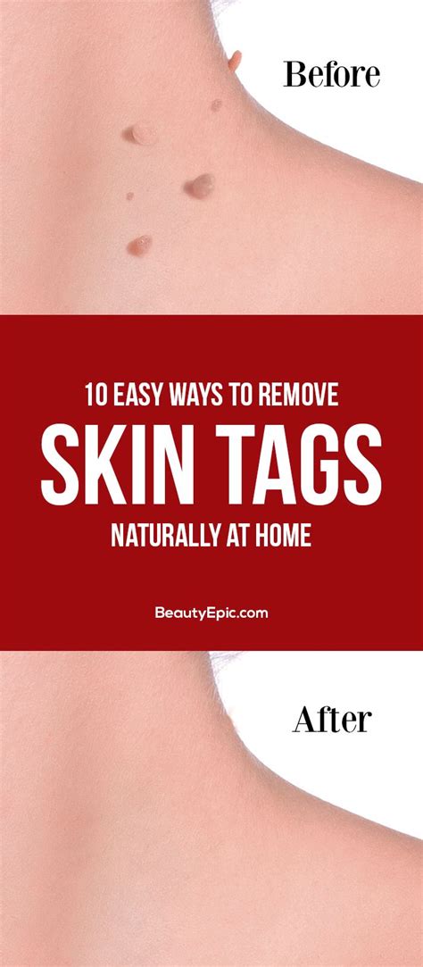 diy ideas 10 easy ways to remove skin tags naturally at home