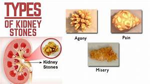 Types Of Kidney Stones Youtube