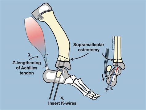 Superankle Paley Orthopedic And Spine Institute