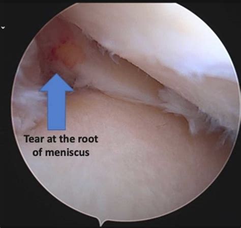 Meniscus Root Tear Repair Orthopedic Knee Surgeon Manhattan New
