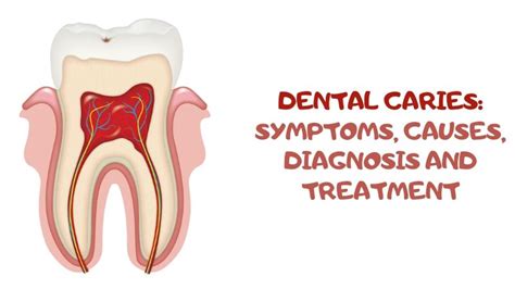 Dental Caries Symptoms Causes Diagnosis And Treatment