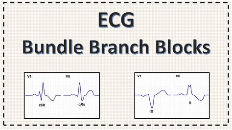 Bundle Branch Block ECG Right Bundle Branch Block Left Bundle Branch Block Explained