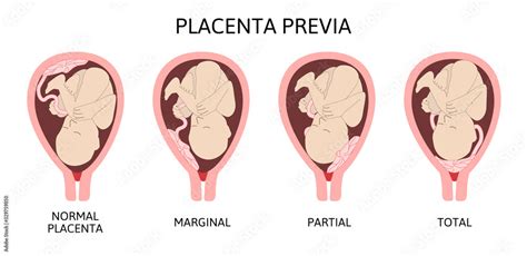 Different Placental Locations During Pregnancy Major And Normal