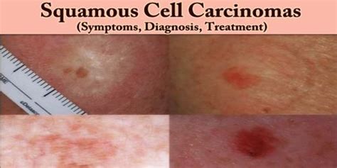 Squamous Cell Carcinomas Symptoms Diagnosis Treatment Assignment