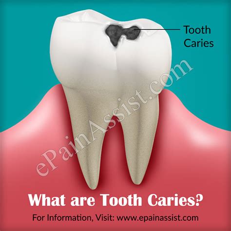 Tooth Cariescausessymptomstreatmentpathophysiologyclassification