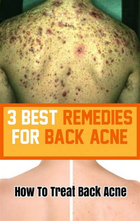3 Best Remedies For Acne Back Acne Remedies Best Acne Remedies Acne