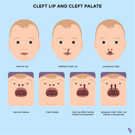 What Is The Chance Of Developing A Cleft Lip