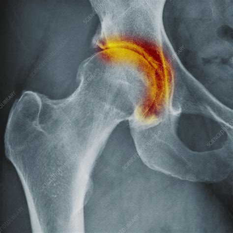 Hip Arthritis X Ray Stock Image C0478903 Science Photo Library