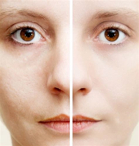 Uneven Skin Tone Causes And Solution Uneven Skin Tone On Body