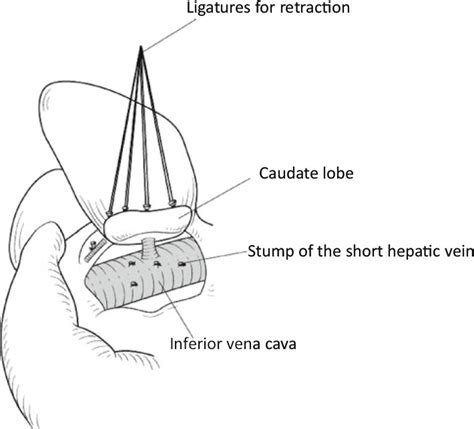 Left Hepatectomy Kobayashi 2012 Journal Of Hepato Biliary