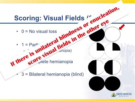 Partial Hemianopia Nih Stroke Scale