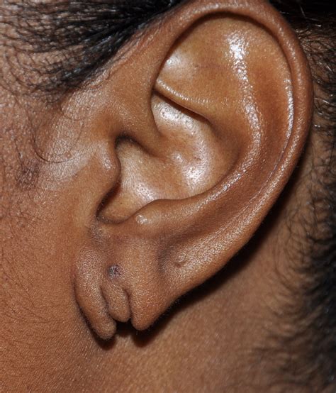 Repair of Torn or Split Earlobes under Local Anesthesia - Explore