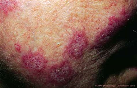 Lupus Picture From Ui Dermatology Discoid Lupus Erythematosus Hardin Md
