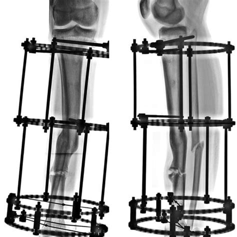 Ap And Lat Radiographs 1 Month After Surgery Demonstrating Maintained