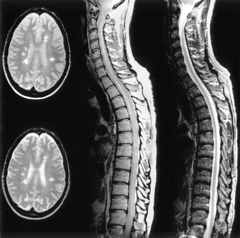 Multiple Sclerosis (MS) | Conway Homer, P.C.