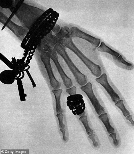 Roentgens First Human X Ray Of His Wifes Hand In 1895 Daily Mail Online