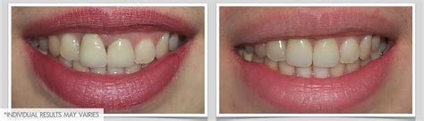 All Ceramic Crown | PMDC Dental