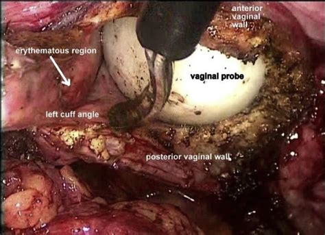 A Rare Cause Of Post Hysterectomy Vaginal Bleeding Vaginal Cuff
