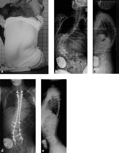 17 Assessing Outcomes In Neuromuscular Scoliosis Musculoskeletal Key