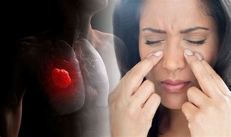 Lung Cancer Symptoms Swelling Of The Face Could Signal The Deadly