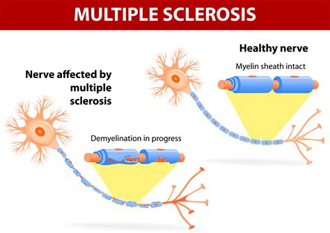 Natural Relief For Symptoms Of Multiple Sclerosis In Sacramento Body