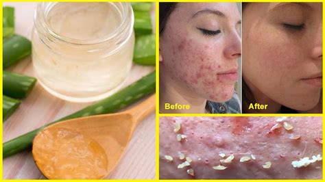 she applied aloe vera gel on her skin for 30 days the result is very shocking youtube