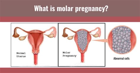 Causes Symptoms And Treatment Of Molar Pregnancy Healofy