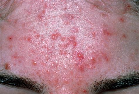 Acne Vulgaris On Forehead Photograph By Dr P Marazziscience Photo Library