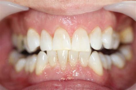 That depends on the whitening treatment chosen. Teeth Whitening with Enlighten Smiles At Southside Dental Care