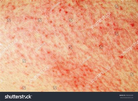 Raised Red Bumps And Blisters Caused By Shingles Stock Photo 258326285