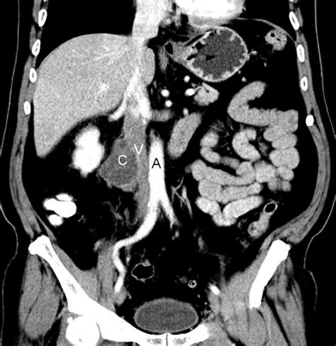 Infected Retroperitoneal Cystic Lymphangioma A Case Report Eurorad