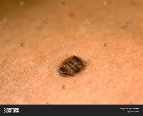 Brown Scaly Spots On Skin