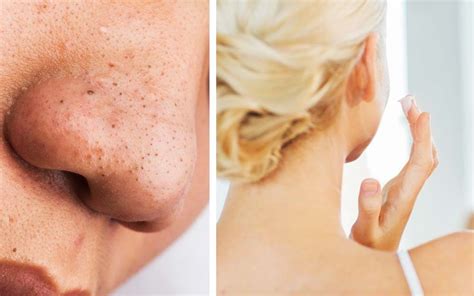 Dr Pimple Poppers Advice On Getting Rid Of Blackheads The Healthy