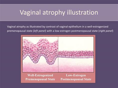 Atrophie Vulvo Vaginale Centre De Bionomie Sexiezpix Web Porn