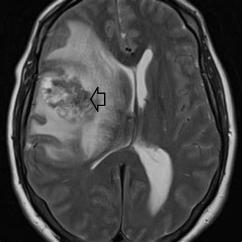 Cureus Brain Metastasis In A Young Patient Consider The Rectum
